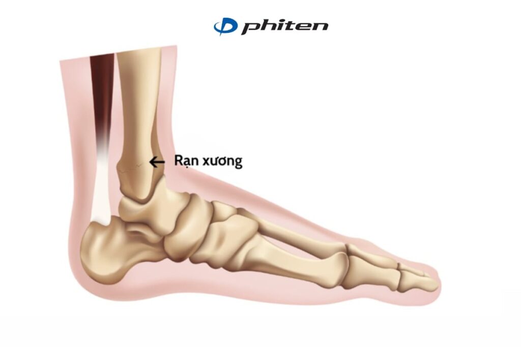 Chấn thương cổ chân khi đá banh do bị Nứt – Rạn – Gãy xương
