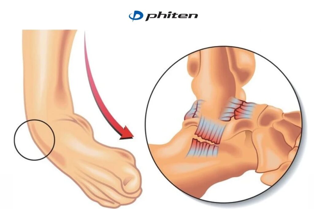 Cách chữa chấn thương cổ chân khi đá bóng do trật khớp