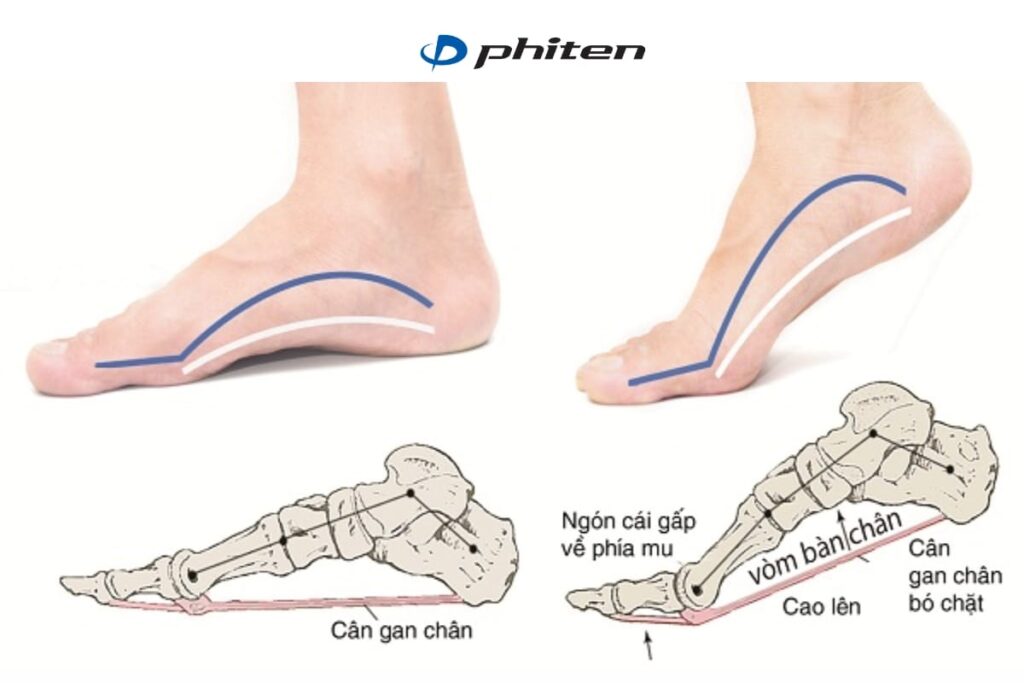 Chấn thương chân khi đá bóng do viêm cân gan chân