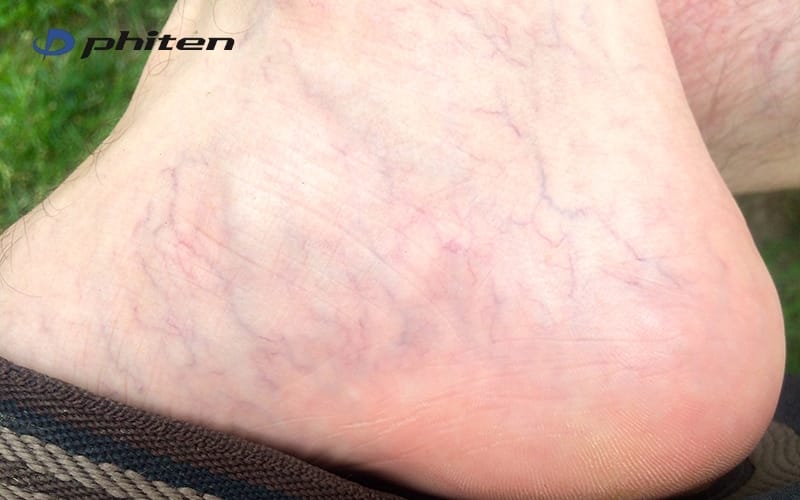 đặc điểm bàn chân bị giãn tĩnh mạch