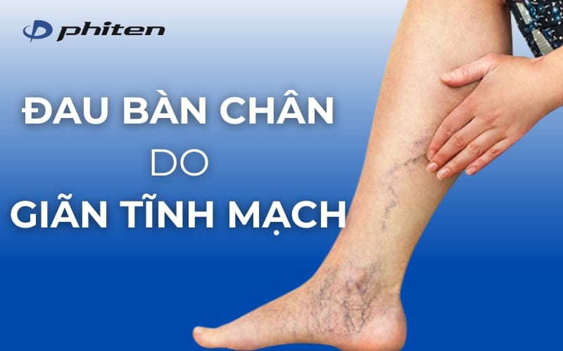 đau bàn chân do giãn tĩnh mạch